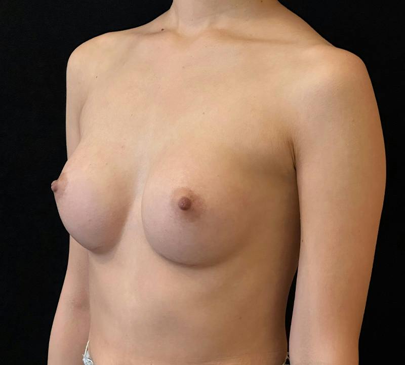 Breast Augmentation Subfascial Before & After Gallery - Patient 369001 - Image 8