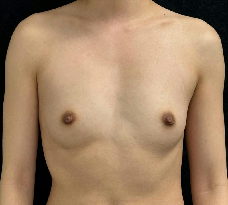 Breast Augmentation Subfascial Before & After Gallery - Patient 194434 - Image 1