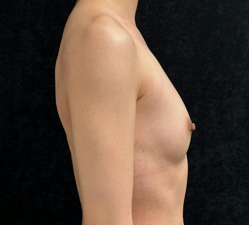 Breast Augmentation Subfascial Before & After Gallery - Patient 194434 - Image 5