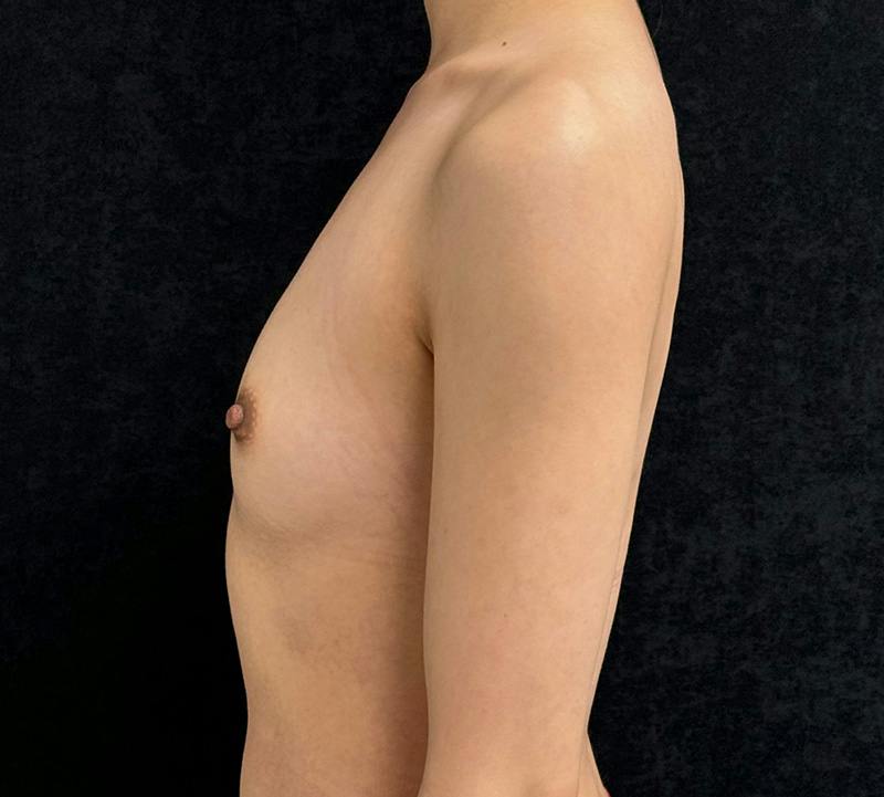 Breast Augmentation Subfascial Before & After Gallery - Patient 194434 - Image 9