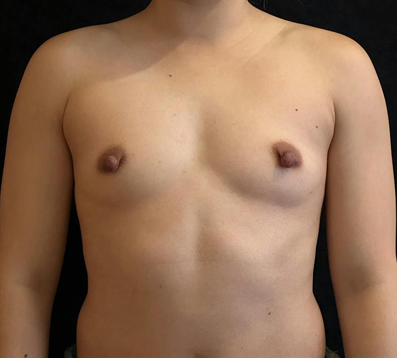 Breast Augmentation Subfascial Before & After Gallery - Patient 174710 - Image 1