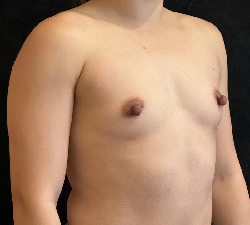 Breast Augmentation Subfascial Before & After Gallery - Patient 174710 - Image 3