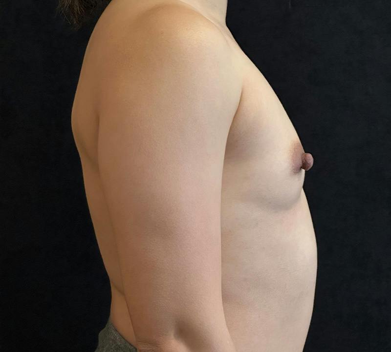 Breast Augmentation Subfascial Before & After Gallery - Patient 174710 - Image 5
