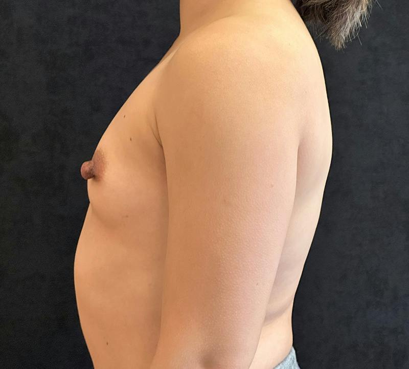 Breast Augmentation Subfascial Before & After Gallery - Patient 174710 - Image 9