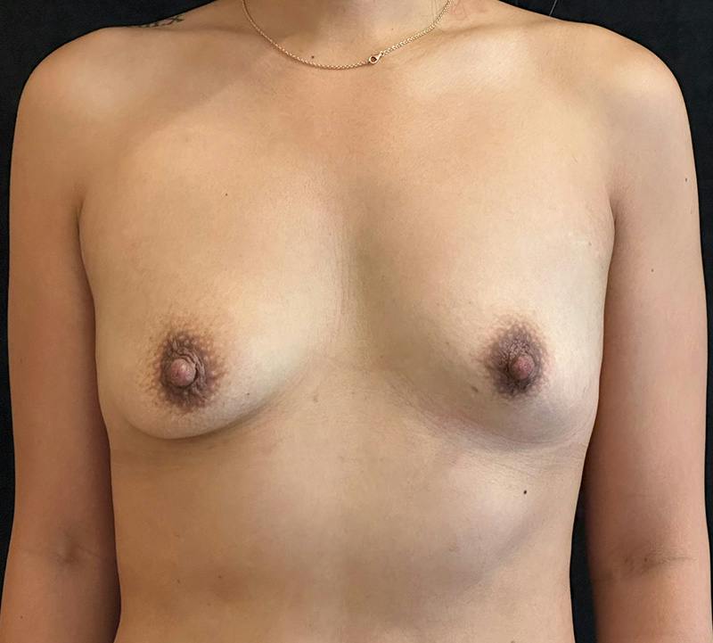 Breast Augmentation Subfascial Before & After Gallery - Patient 523509 - Image 1