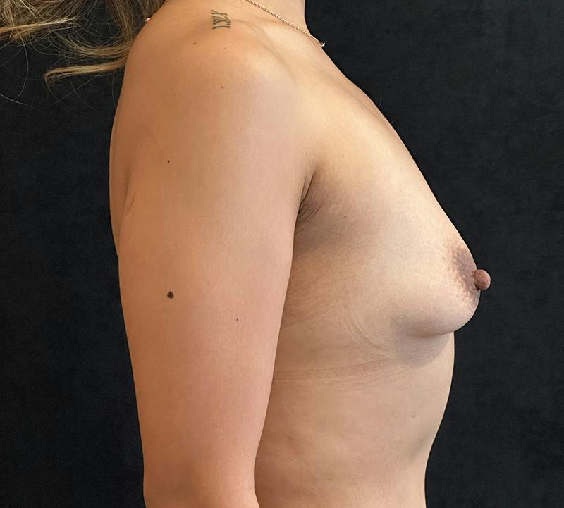 Breast Augmentation Subfascial Before & After Gallery - Patient 523509 - Image 5