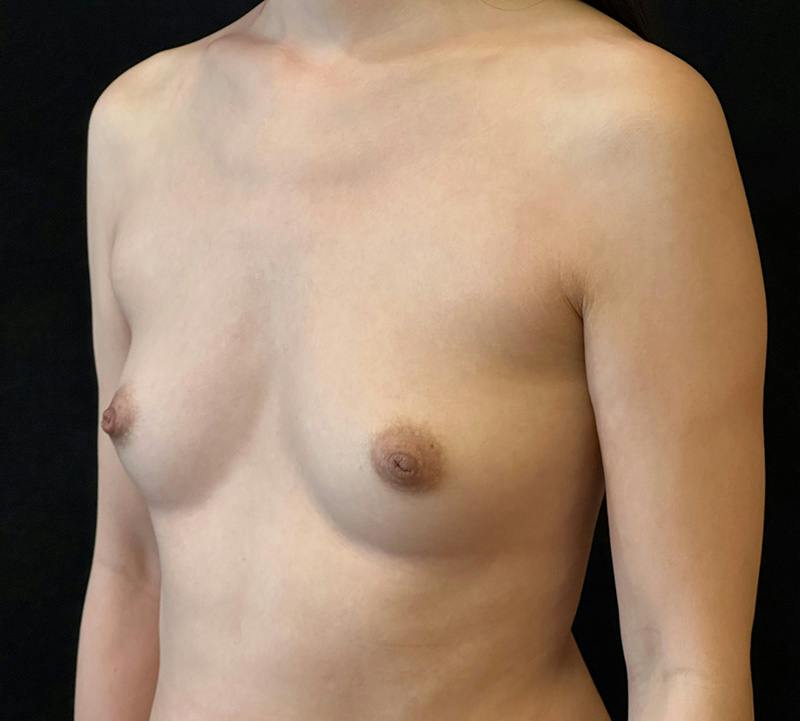 Breast Augmentation Subfascial Before & After Gallery - Patient 369071 - Image 7