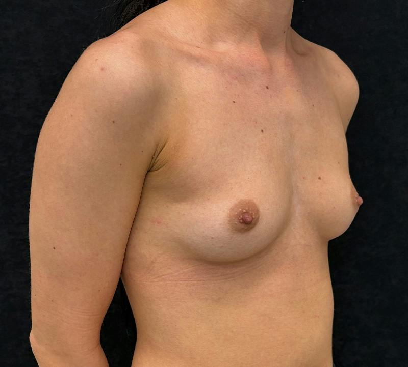 Breast Augmentation Subfascial Before & After Gallery - Patient 175724 - Image 3