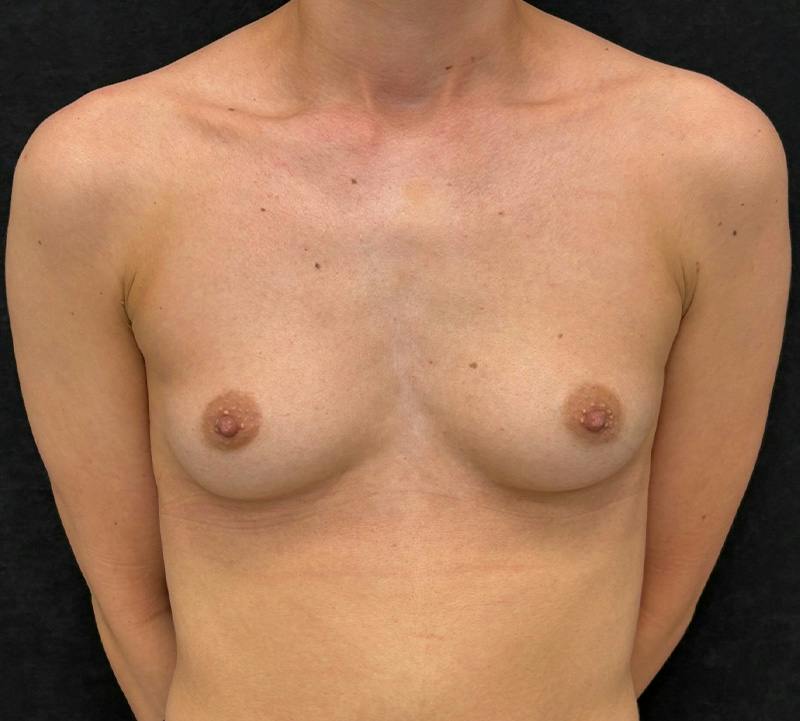 Breast Augmentation Subfascial Before & After Gallery - Patient 175724 - Image 1