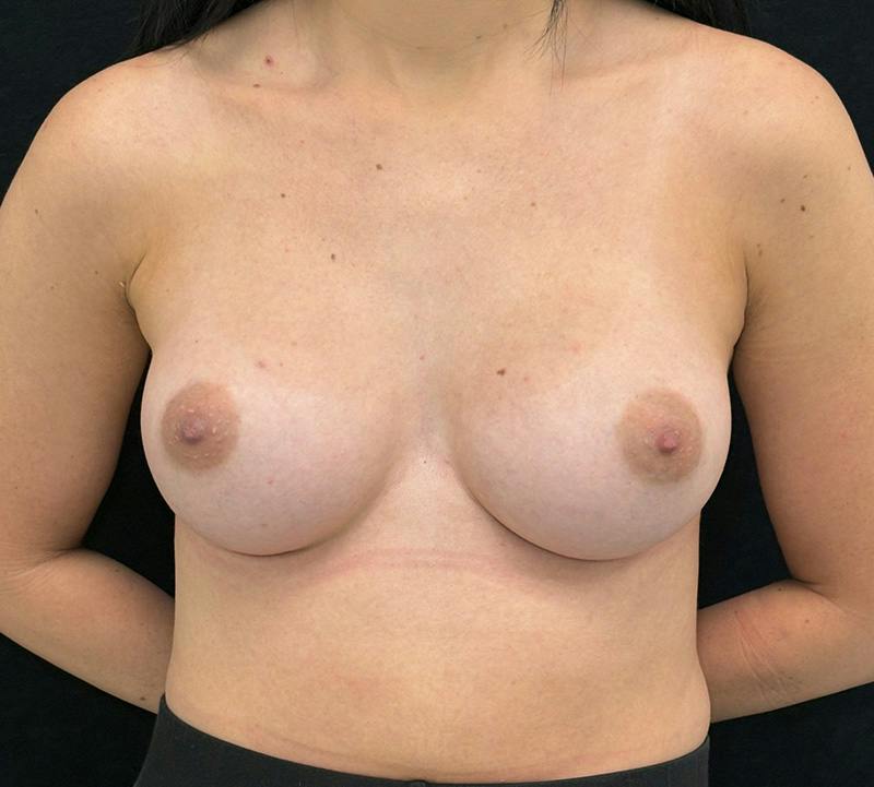 Breast Augmentation Subfascial Before & After Gallery - Patient 175724 - Image 2