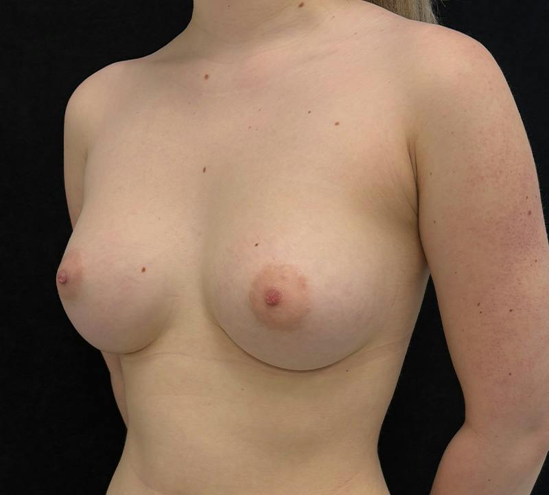 Breast Augmentation Subfascial Before & After Gallery - Patient 264598 - Image 8