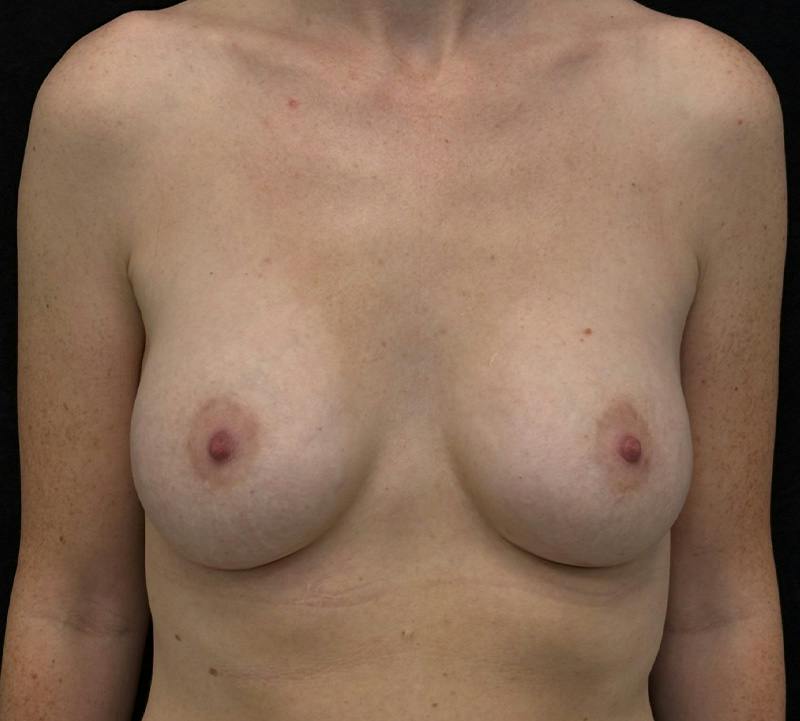 Breast Augmentation Subfascial Before & After Gallery - Patient 213961 - Image 2