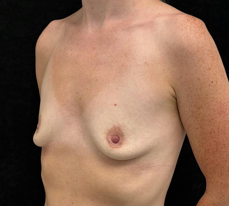 Breast Augmentation Subfascial Before & After Gallery - Patient 213961 - Image 7