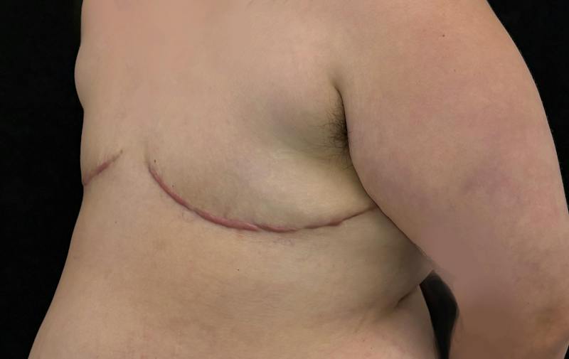 Top Surgery Before & After Gallery - Patient 134016 - Image 8