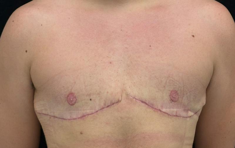 Top Surgery Before & After Gallery - Patient 376320 - Image 2