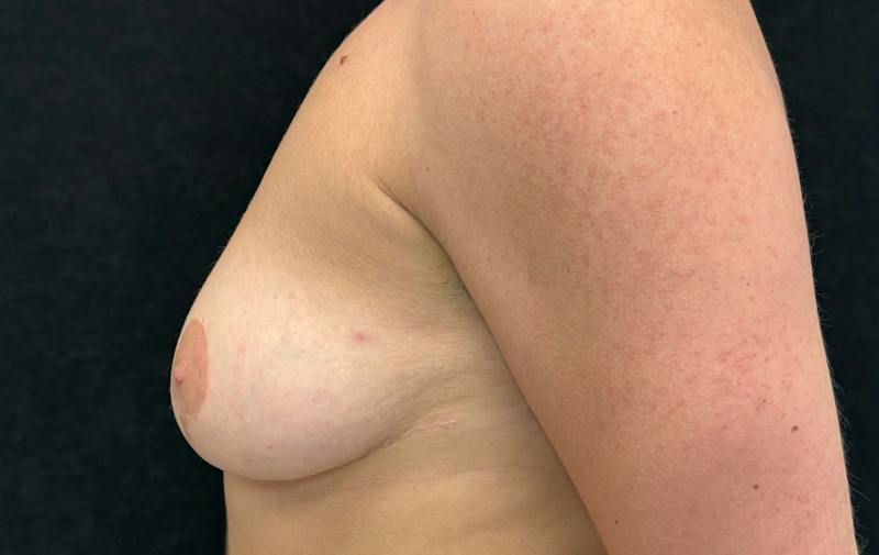 Top Surgery Before & After Gallery - Patient 376320 - Image 9