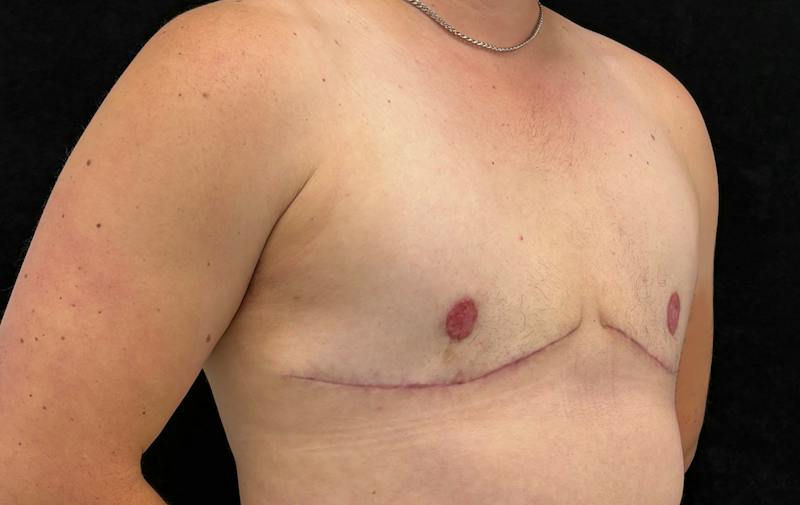 Top Surgery Before & After Gallery - Patient 526045 - Image 4