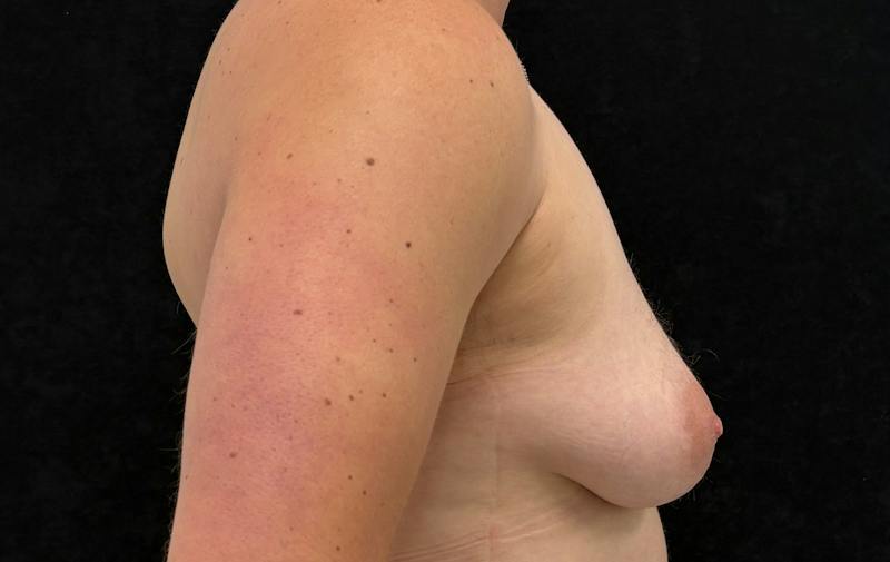 Top Surgery Before & After Gallery - Patient 526045 - Image 5