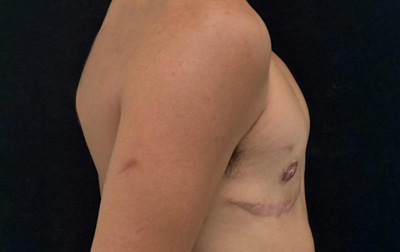 Top Surgery Before & After Gallery - Patient 114131 - Image 6