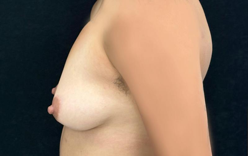 Top Surgery Before & After Gallery - Patient 114131 - Image 9