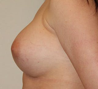 Breast Augmentation Before & After Gallery - Patient 127802612 - Image 10