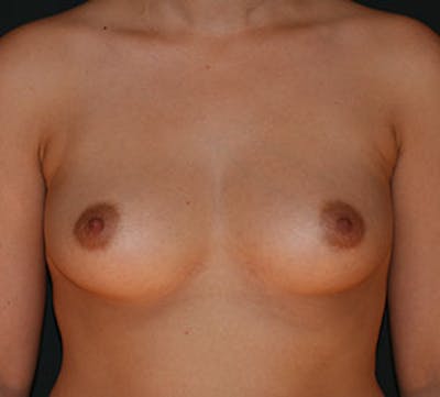 Breast Augmentation Before & After Gallery - Patient 127860406 - Image 1