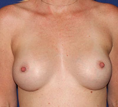 Breast Augmentation Before & After Gallery - Patient 127860414 - Image 2