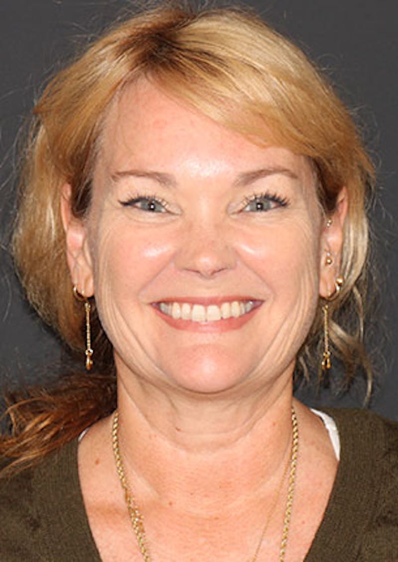 Facelift/Necklift Before & After Gallery - Patient 3869575 - Image 3