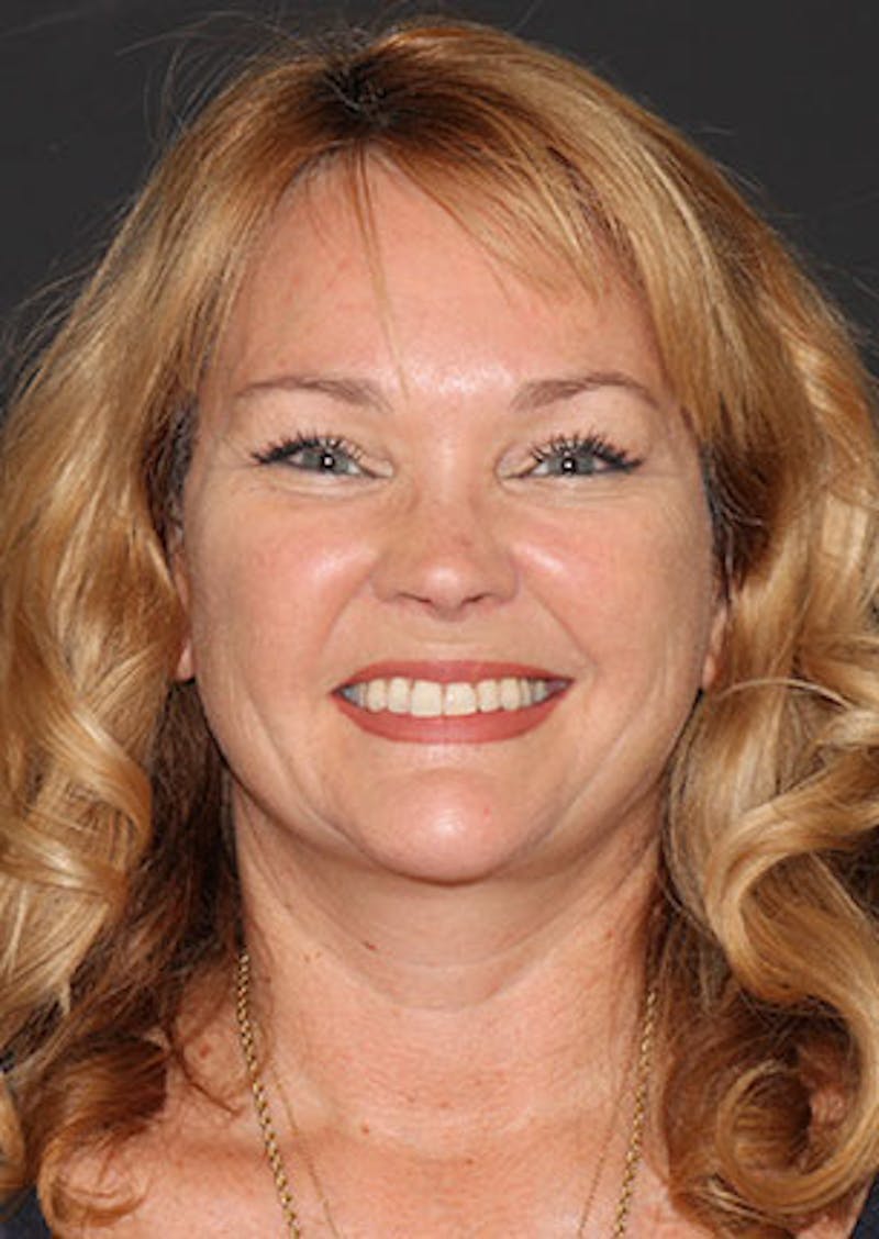 Facelift/Necklift Before & After Gallery - Patient 3869575 - Image 4