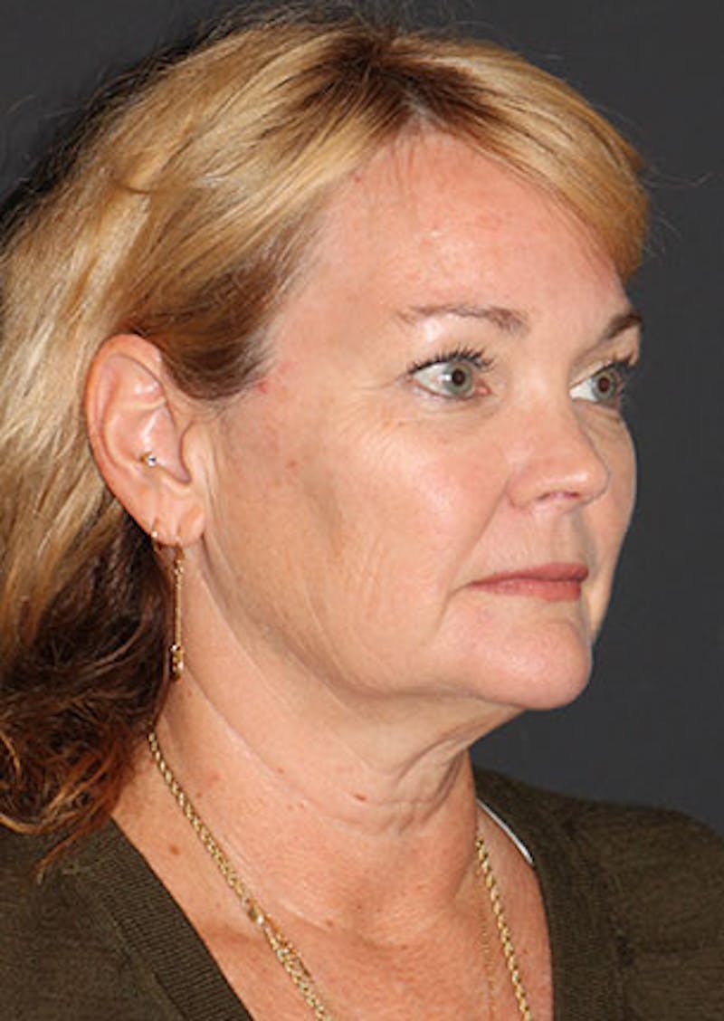 Facelift/Necklift Before & After Gallery - Patient 3869575 - Image 5