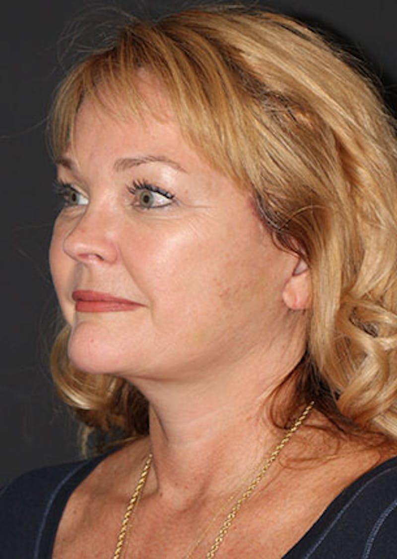 Facelift/Necklift Before & After Gallery - Patient 3869575 - Image 8