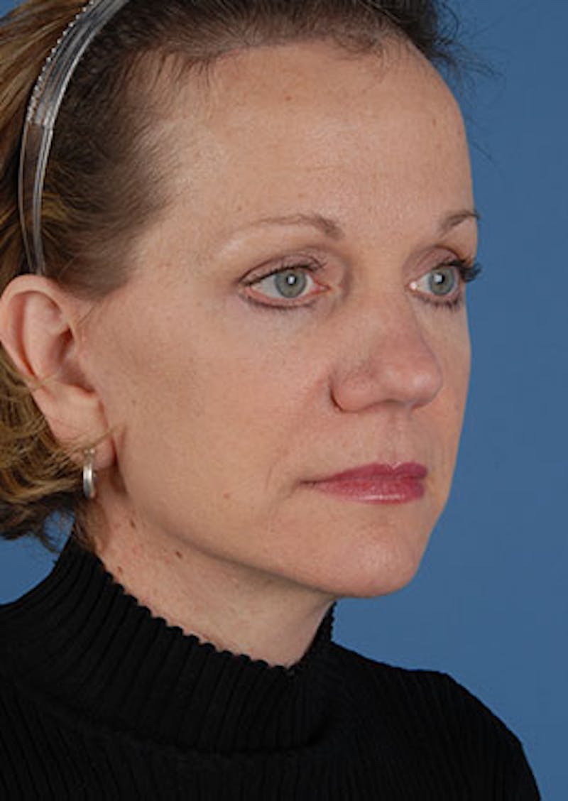 Facelift/Necklift Before & After Gallery - Patient 3869584 - Image 4