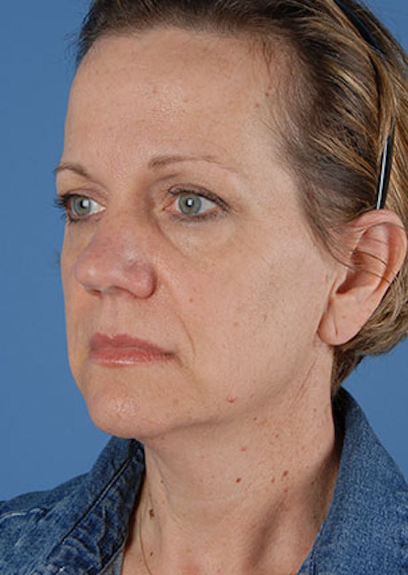 Facelift/Necklift Before & After Gallery - Patient 3869584 - Image 5