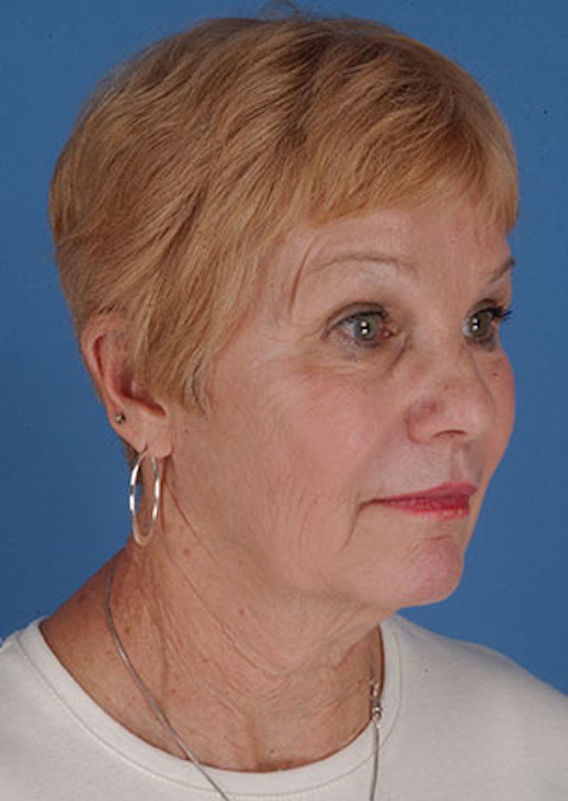 Facelift/Necklift Before & After Gallery - Patient 3869585 - Image 3