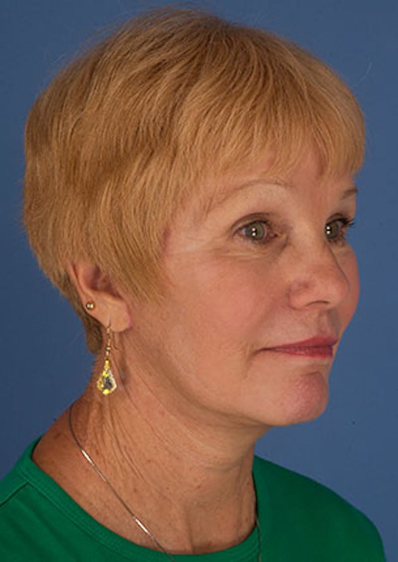 Facelift/Necklift Before & After Gallery - Patient 3869585 - Image 4