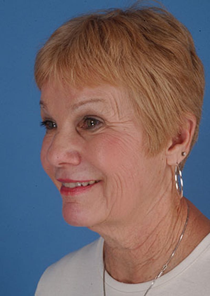 Facelift/Necklift Before & After Gallery - Patient 3869585 - Image 5