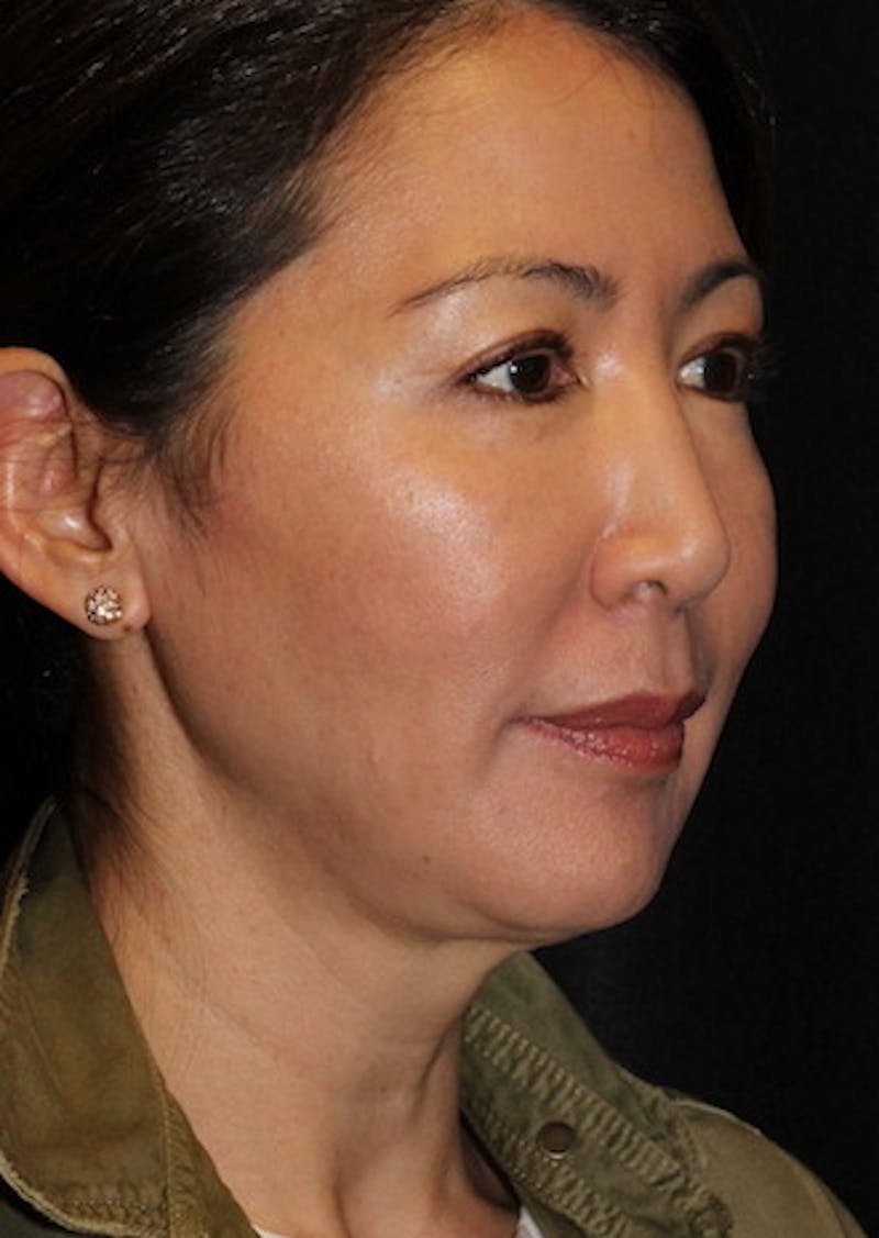 Facetite Before & After Gallery - Patient 3869589 - Image 3