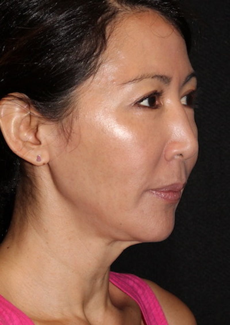 Facetite Before & After Gallery - Patient 3869589 - Image 4