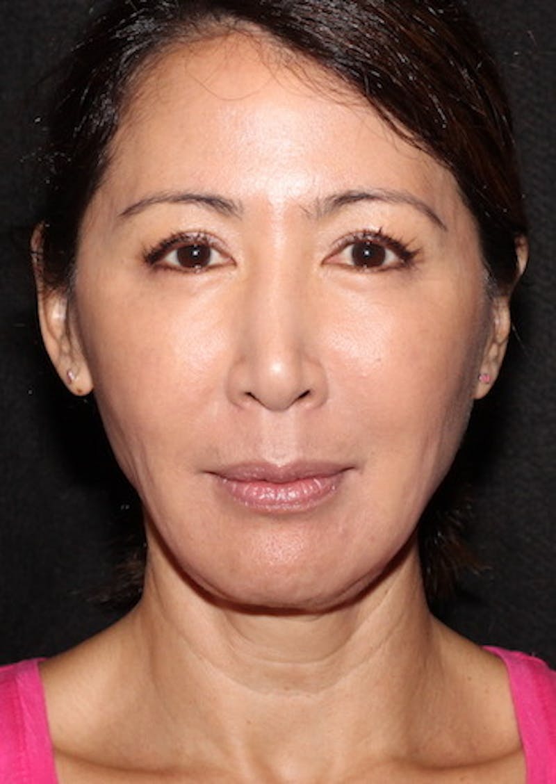 Facetite Before & After Gallery - Patient 3869589 - Image 6