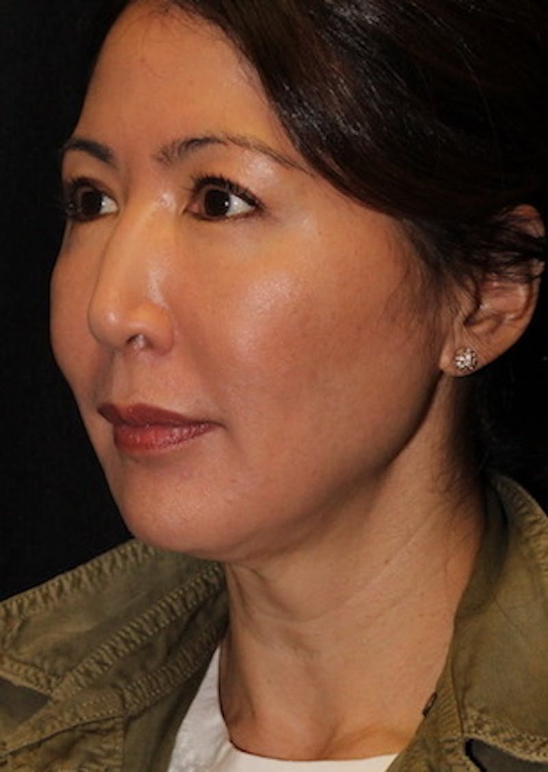 Facetite Before & After Gallery - Patient 3869589 - Image 7