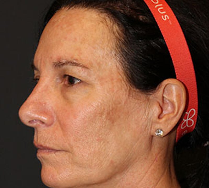 Browlift/Upper Blepharoplasty Before & After Gallery - Patient 3869590 - Image 7