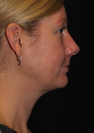 Facetite Before & After Gallery - Patient 3869591 - Image 1