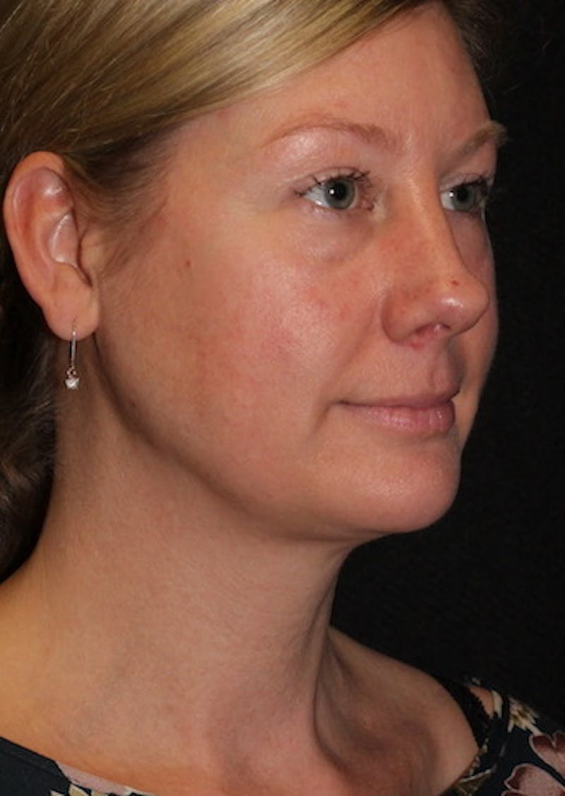 Facetite Before & After Gallery - Patient 3869591 - Image 3