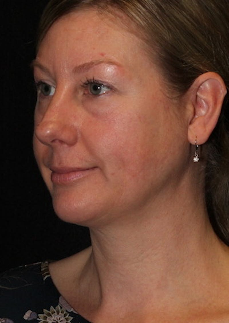 Facetite Before & After Gallery - Patient 3869591 - Image 7
