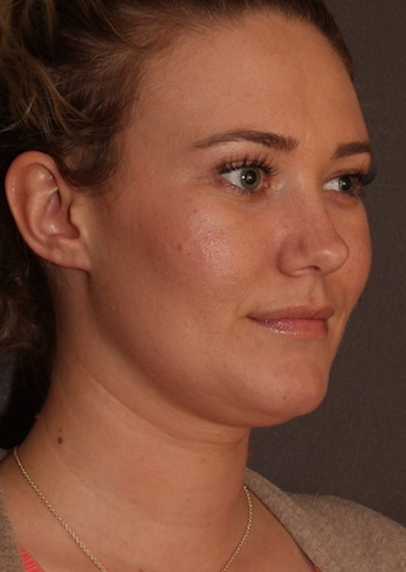 Facetite Before & After Gallery - Patient 3869596 - Image 3