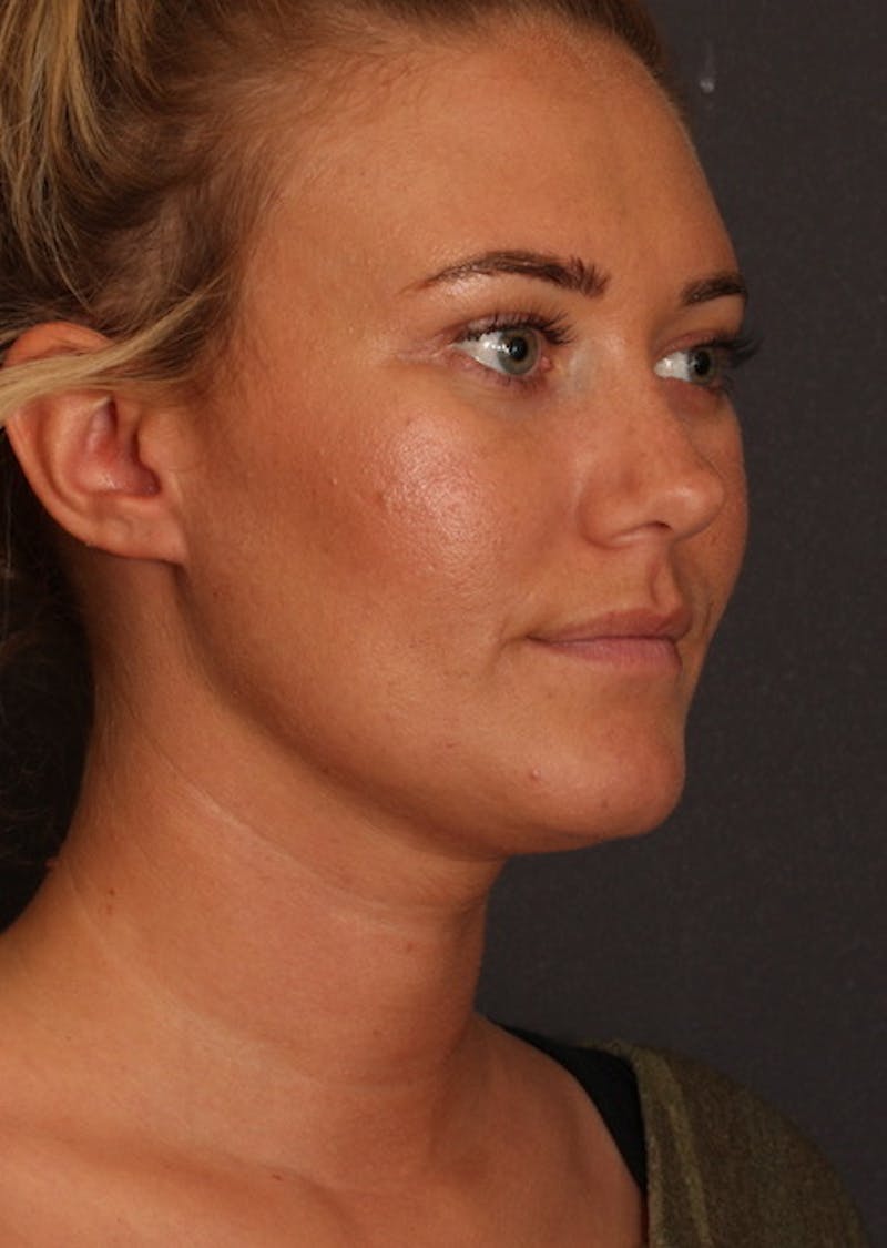 Facetite Before & After Gallery - Patient 3869596 - Image 4