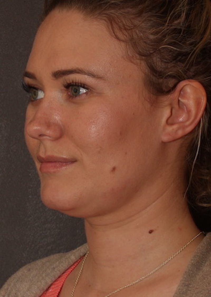 Facetite Before & After Gallery - Patient 3869596 - Image 7