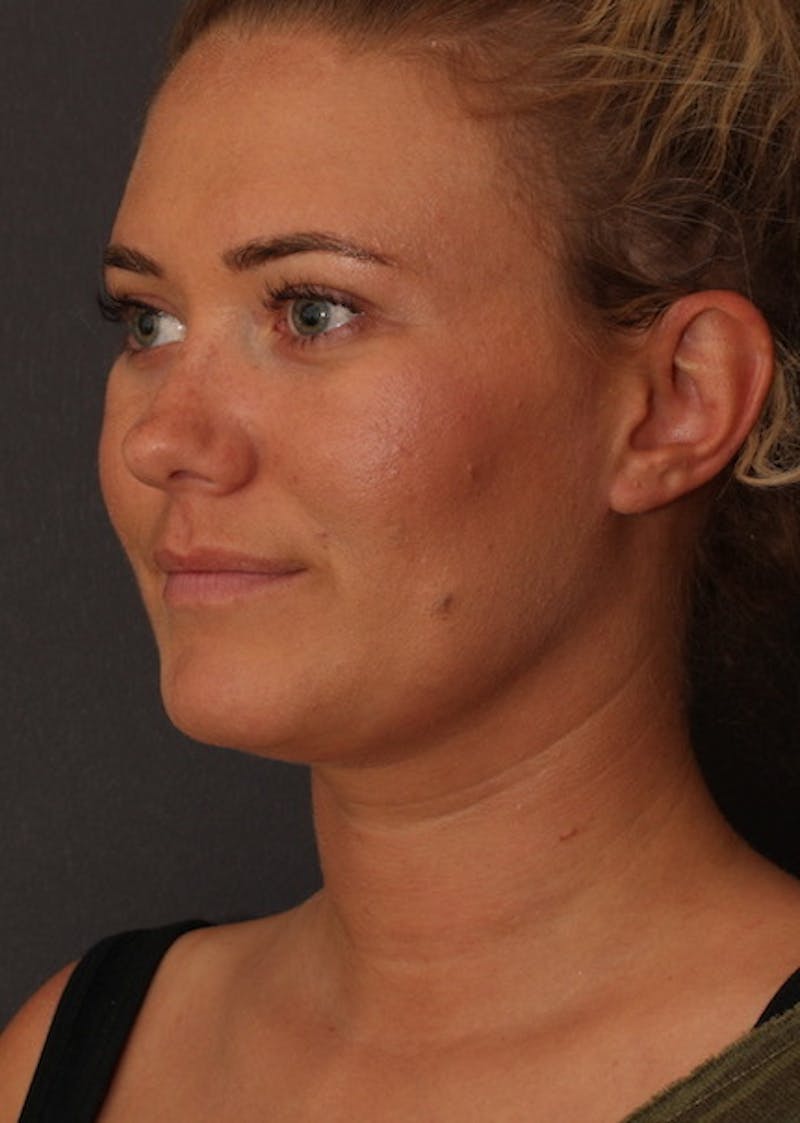 Facetite Before & After Gallery - Patient 3869596 - Image 8