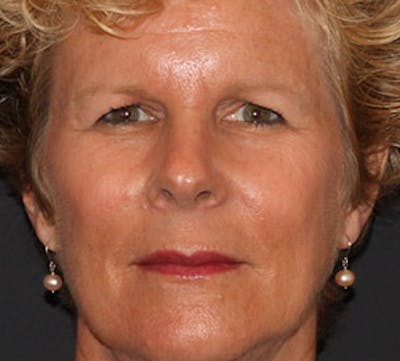 Browlift/Upper Blepharoplasty Before & After Gallery - Patient 3869601 - Image 1