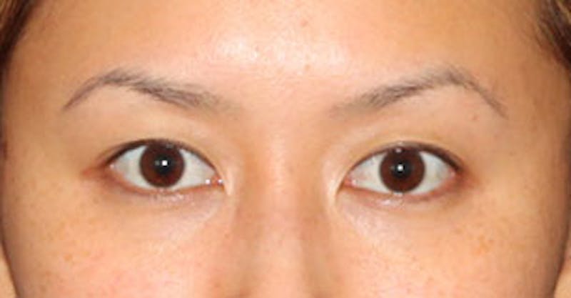 Asian (Double) Eyelid Before & After Gallery - Patient 3869599 - Image 1